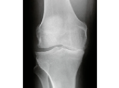Diagnosis of knee joint arthrosis