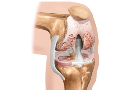 arthritis or arthritis of changes
