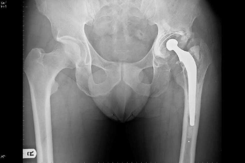 Coxartrosis