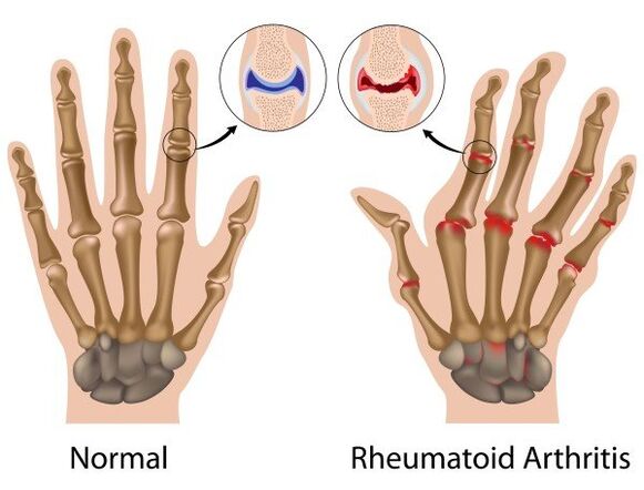 Finger joints without pathology and with rheumatoid arthritis