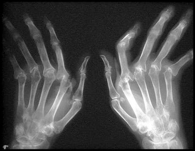 Photo x -Ray of hands affected by arthrosis