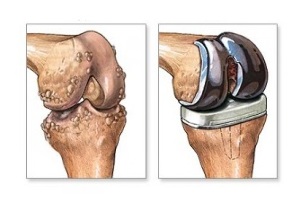 knee replacement for osteoarthritis