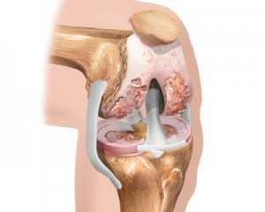 the initial stage of knee osteoarthritis