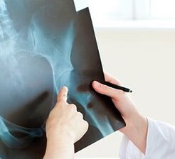 How to treat hip joint arthrosis