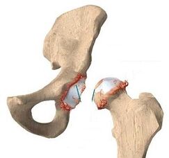 Reasons for developing hip union arthrosis