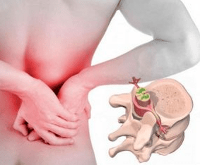 Lumbago at the beginning of osteochondrosis disease