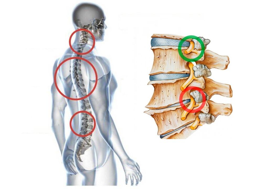 It looks like osteochondrosis of the cervical vertebrae