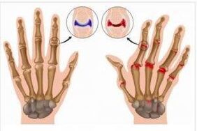 Changes between arthritis and arthrosis of the hands