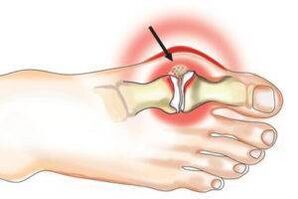 Joint damage due to arthritis and arthritis