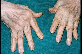 Symptoms of arthritis in the fingers