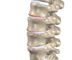 development of spinal osteochondrosis
