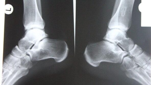 Diagnosis of ankle arthrosis using radiographs