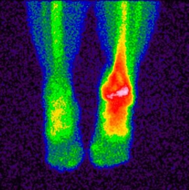 The method of differential diagnosis of crucarthrosis is scintigraphy